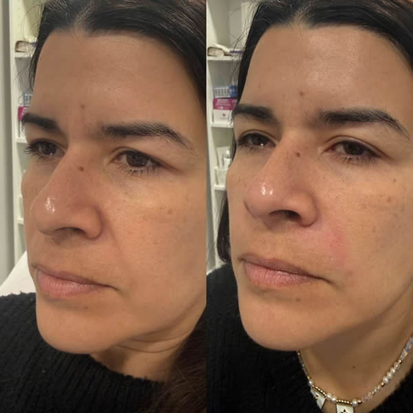 Armonización Facial