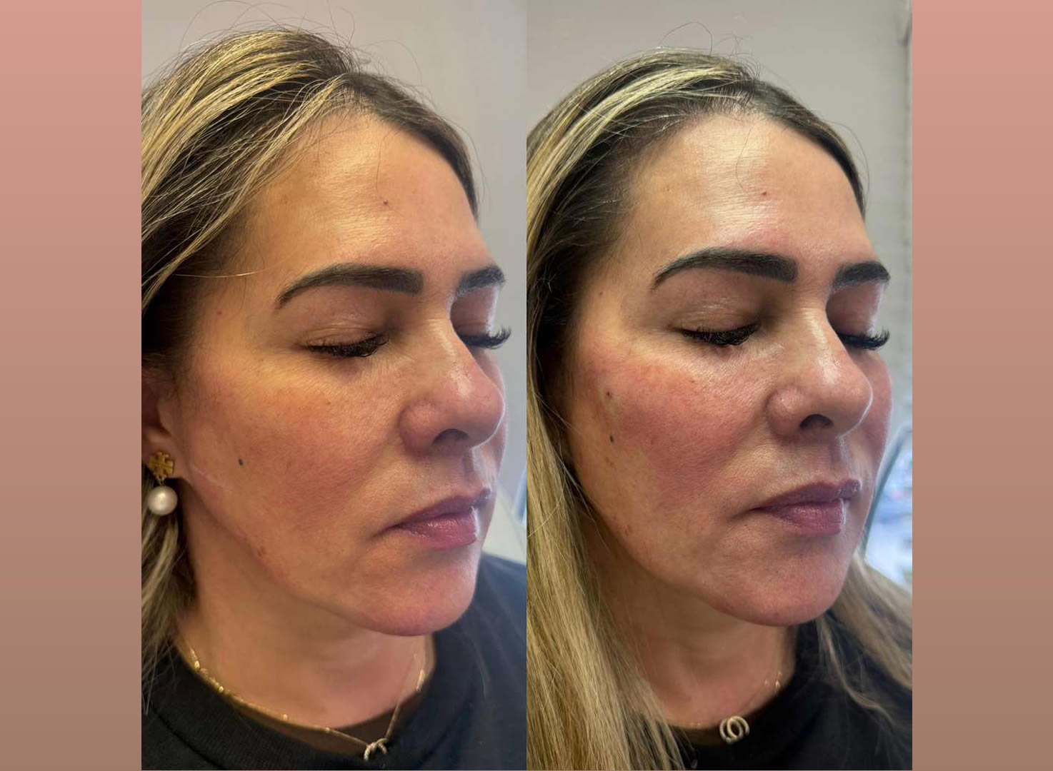 Armonización Facial